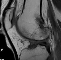 Revision ACL MRI Pre Sagittal 2